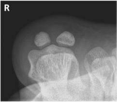 Fig. 6.52 tangențial incidență—pacient Decubit ventral.