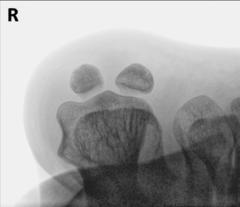 Fig. 6.53 Alternative incidență—pacient Decubit dorsal.