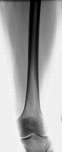 Fig. 7.37 AP—mid și distal Femur.