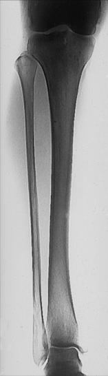Fig. 6.98 AP Gambă—include ambele articulații.