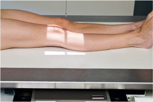 Fig. 6.103 AP Genunchi—Raza centrală (RC) perpendiculară pe receptorul de imagine (average pacient—19 la