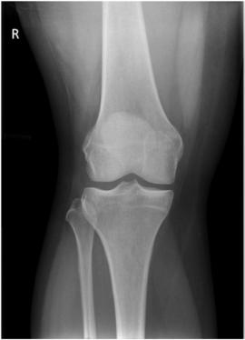 Fig. 6.104 AP Genunchi—0° raza centrală. (Courtesy Joss Wertz, DO.)