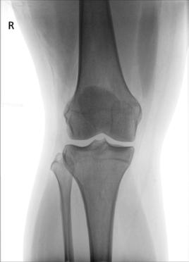 Fig. 6.105 AP Genunchi—0° raza centrală. (Courtesy Joss Wertz, DO.)