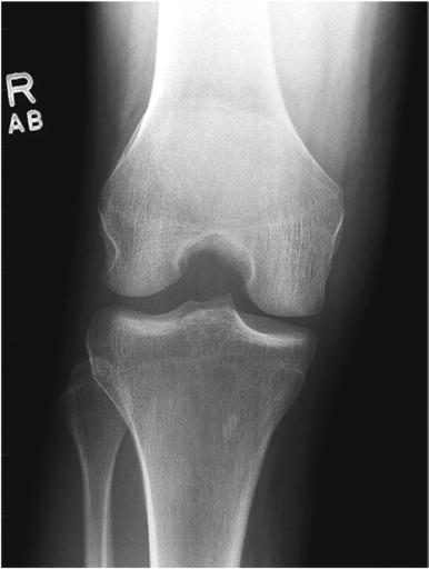 Fig. 6.129 AP axial—40° flexion și raza centrală angle.