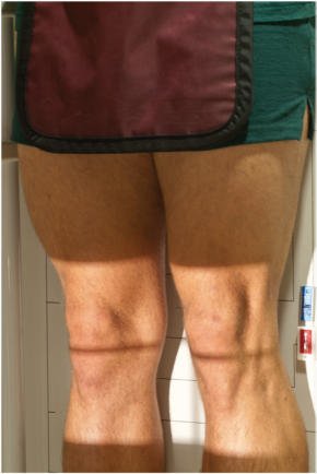 Fig. 6.115 AP bilateral weight-