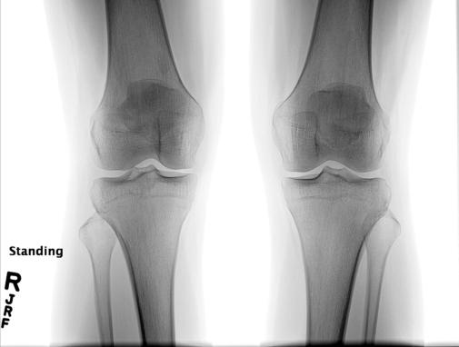 Fig. 6.116 AP bilateral weight-
