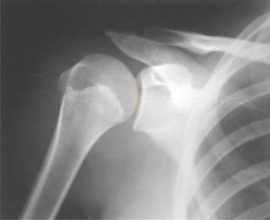 Fig. 5.59 AP Incidență Oblică—drept posterior oblic (RPO)