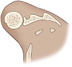 Fig. 5.61 AP Incidență Oblică (Grashey method).