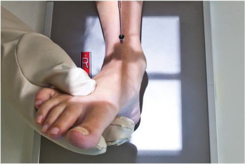 Fig. 6.95 AP Gleznă (Articulație Talocrurală)—eversion stress.