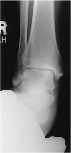 Fig. 6.97 Eversion stress.