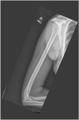 Fig. 5.32 Ortostatism mediolateral Humerus incidență. (Courtesy Joss