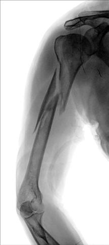 Fig. 5.38 suspiciune de fractură de proximal Humerus, neutral rotație. This este a