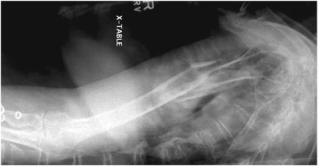 Fig. 5.39 Decubit transthoracic Incidență de Profil (lateral) de Humerus.