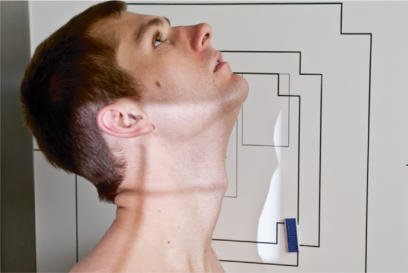 Fig. 8.65 Hiperflexie.