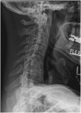 Fig. 8.67 Hiperflexie.