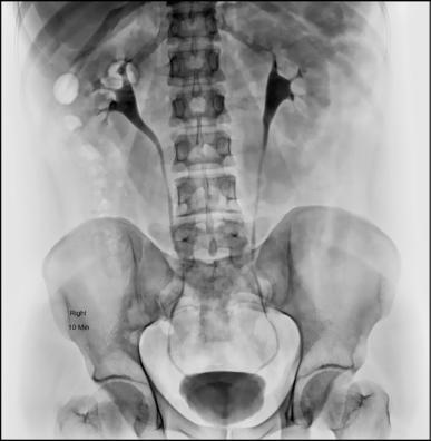 Fig. 14.72 IVU (10 minute). (Caz oferit prin amabilitatea Dr MT Niknejad,