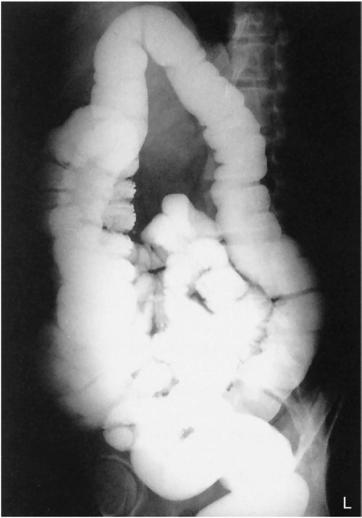 Fig. 13.68 LAO (centrată sus pentru a include flexura colică stângă).