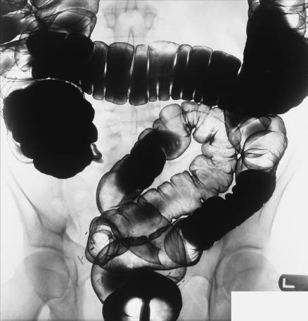 Fig. 13.89 PA axială (dublu-