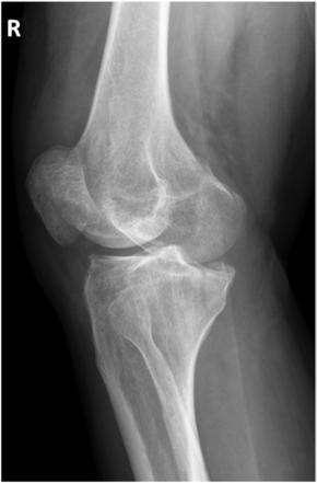 Fig. 6.111 AP lateral oblic. (Courtesy Joss Wertz, DO.)