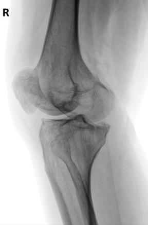 Fig. 6.109 AP lateral oblic.