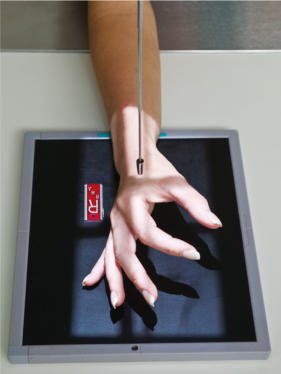 Fig. 4.75 pacient poziție—fan lateral Mână (falange kept separated și