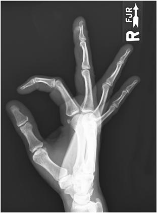 Fig. 4.76 Fan Incidență de Profil (lateral).