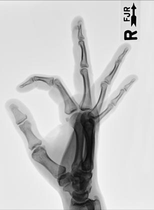 Fig. 4.77 Fan Incidență de Profil (lateral) de drept Mână.