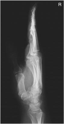 Fig. 4.80 lateral în