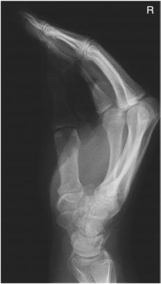 Fig. 4.81 lateral în flexion.