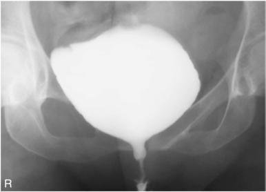 Fig. 14.91 AP, femeie.