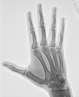 Fig. 4.72 PA oblic Mână (falange