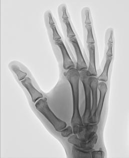 Fig. 4.73 PA oblic Mână (falange