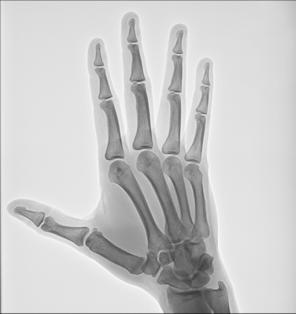 Fig. 4.74 PA oblic Mână (falange paralel).