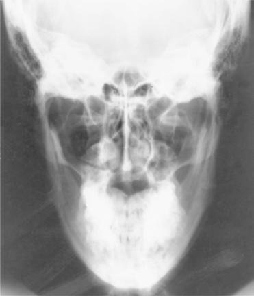 Fig. 11.163 AP axială—raza centrală de la 35° la 40° față de linia orbitomeatală (LOM), în ortostatism și decubit dorsal (casetă inserată).