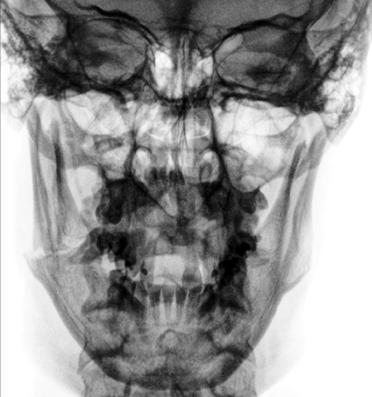 Fig. 11.162 PA axială opțională — raza centrală cu 20° la 25° cranial.
