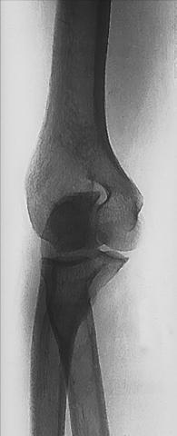 Fig. 4.140 End incidență, evidențiind 45° medial