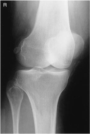 Fig. 6.107 AP medial oblic.