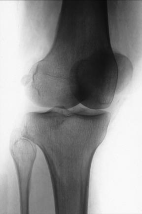 Fig. 6.108 AP medial oblic.