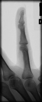 Fig. 4.42 Fifth falange (lateral