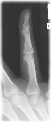 Fig. 4.43 Fourth falange