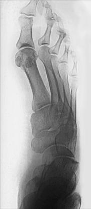 Fig. 6.59 30° la 40° AP medial oblic.