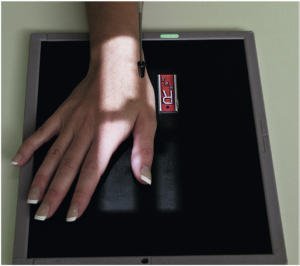 Fig. 4.55 PA oblic Police—raza centrală la first articulații metacarpofalangiene (MCF).