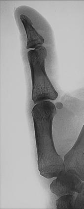 Fig. 4.56 PA oblic