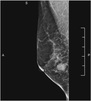 Fig. 20.72 ML incidență.