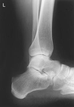 Fig. 6.92 Mediolateral Gleznă (Articulație Talocrurală).