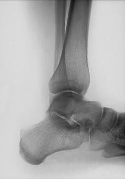 Fig. 6.93 Mediolateral Gleznă (Articulație Talocrurală).