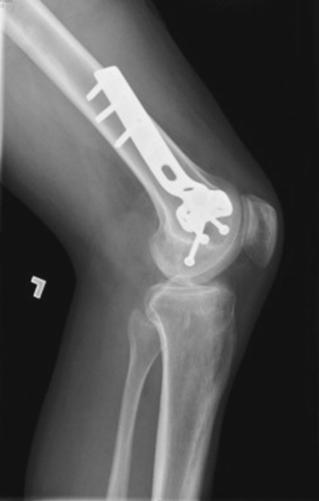 Fig. 7.40 lateral—mid și distal Femur. (de la Fagan R, Furey AJ: