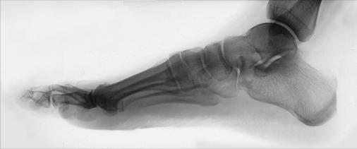 Fig. 6.65 Mediolateral Picior.