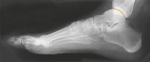 Fig. 6.66 Mediolateral Picior.