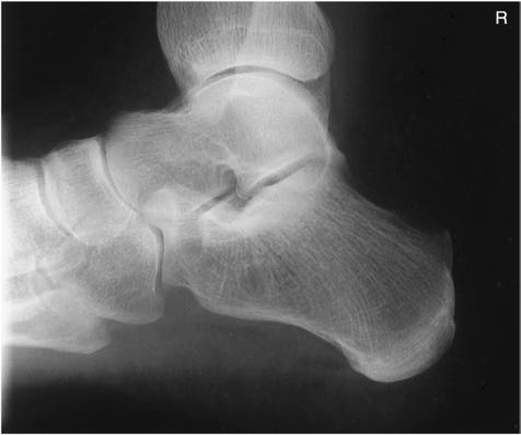 Fig. 6.76 Mediolateral Calcaneu.